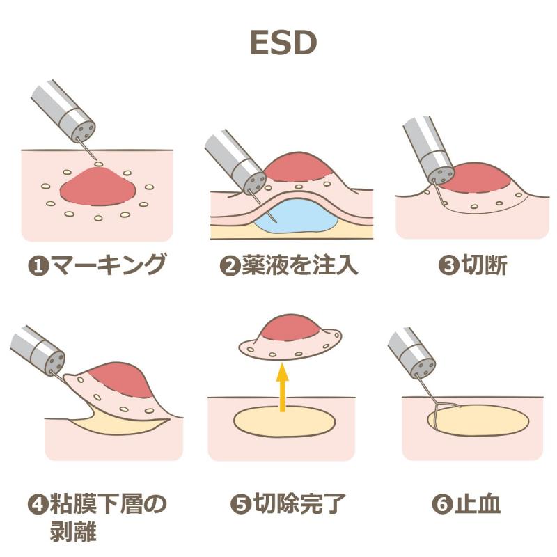 esd
