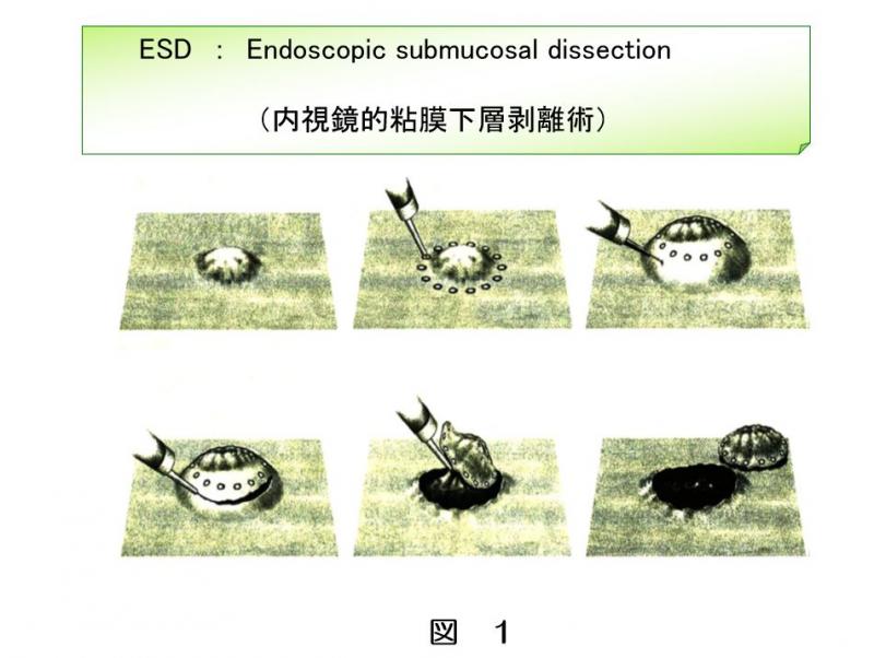 図1電気メスを用いてがんを切りはがしていく内視鏡的粘膜下層剥離術の様子