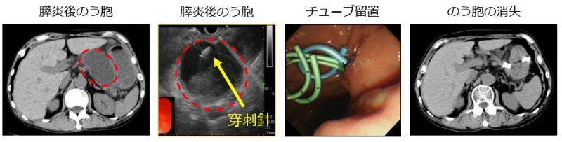 膵のう胞ドレナージ治療