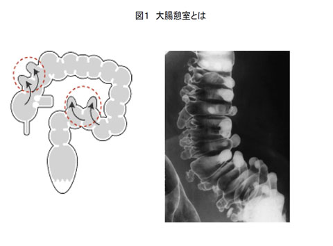 図1：大腸憩室とは。イメージ図とレントゲン写真。