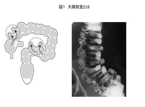 炎 原因 憩室 大腸