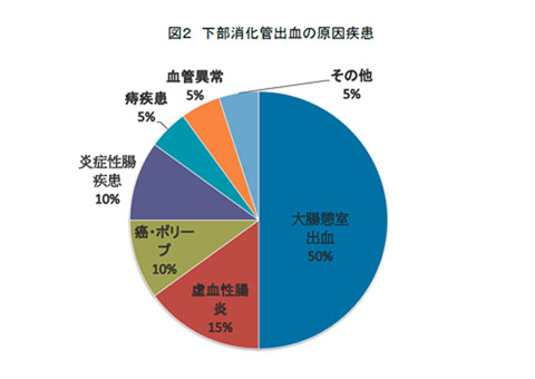 図2：下部消化管出血の原因疾患についての円グラフ。大腸憩室出血50％、虚血性腸炎15％、がん・ポリープ10％、炎症性腸疾患10％、痔疾患5％、血管異常5％、その他5％で計100％となります。