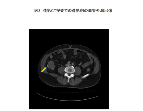 図3：造影CT検査での造影剤の血管外漏出像