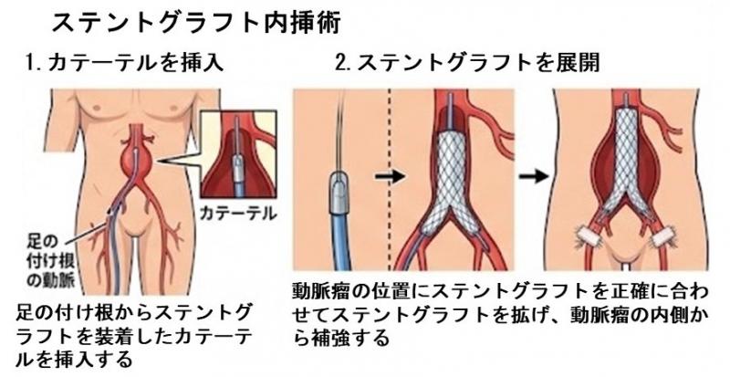 stentgraft